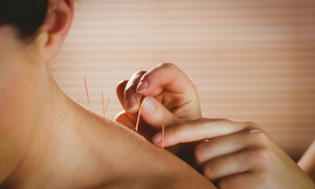 woman acupuncture needles